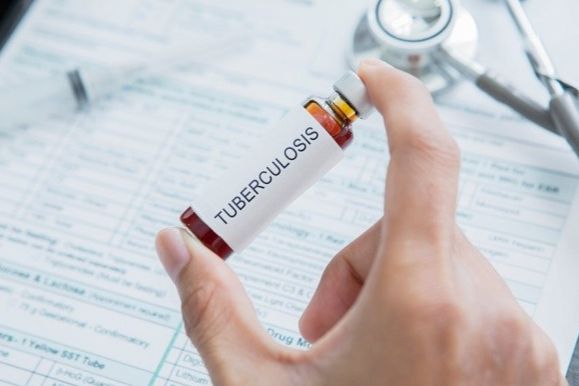 BPOM Pastikan Uji Vaksin TB Banyak Manfaat, Kemenkes Target Vaksin TB sudah Ada Tahun 2028