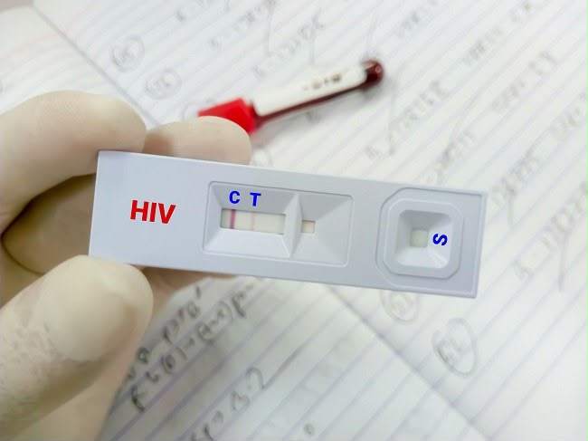 180 Kasus Baru AIDS Ditemukan di Samarinda