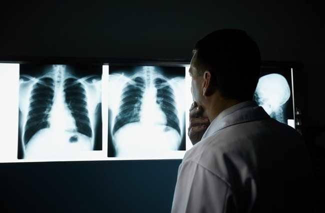 Kenali Tanda Awal Kanker Paru-Paru yang Sering Diabaikan