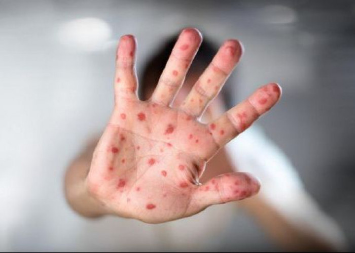 105 Suspek Campak Ditemukan di Kukar, Samboja Paling Banyak