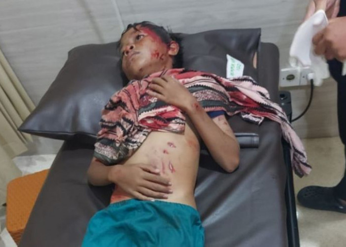 Abisar Kritis Tanpa Jaminan Kesehatan, Bocah Korban Diterkam Buaya di Bontang