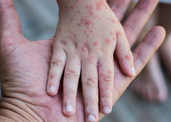 Suspek Campak di Kutim Tembus 105 Kasus, Cakupan Imunisasi Ditingkatkan