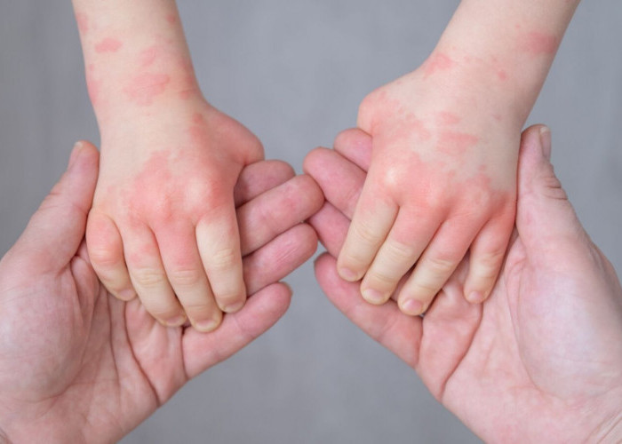 169 Kasus Campak Terjadi di Bontang, Dinkes Sebut Akibat Imunisasi Tidak Lengkap