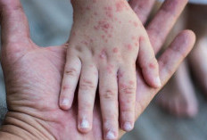 Suspek Campak di Kutim Tembus 105 Kasus, Cakupan Imunisasi Ditingkatkan