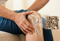 Usia 40-an Waspadai Osteoporosis, Kenali 4 Tanda Awal dan Cara Mencegahnya