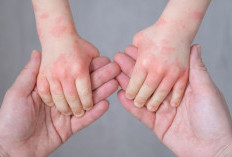 169 Kasus Campak Terjadi di Bontang, Dinkes Sebut Akibat Imunisasi Tidak Lengkap